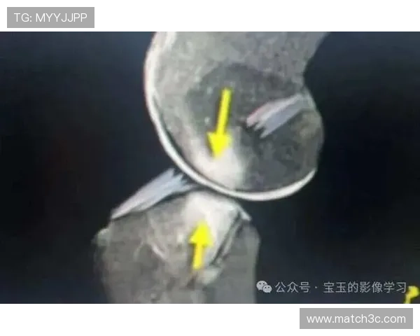 围绕十字韧带撕裂的成因诊断治疗与康复全解析及预防策略与运动风险评估 - 副本 (2)